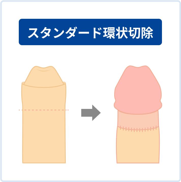 スタンダード環状切除
