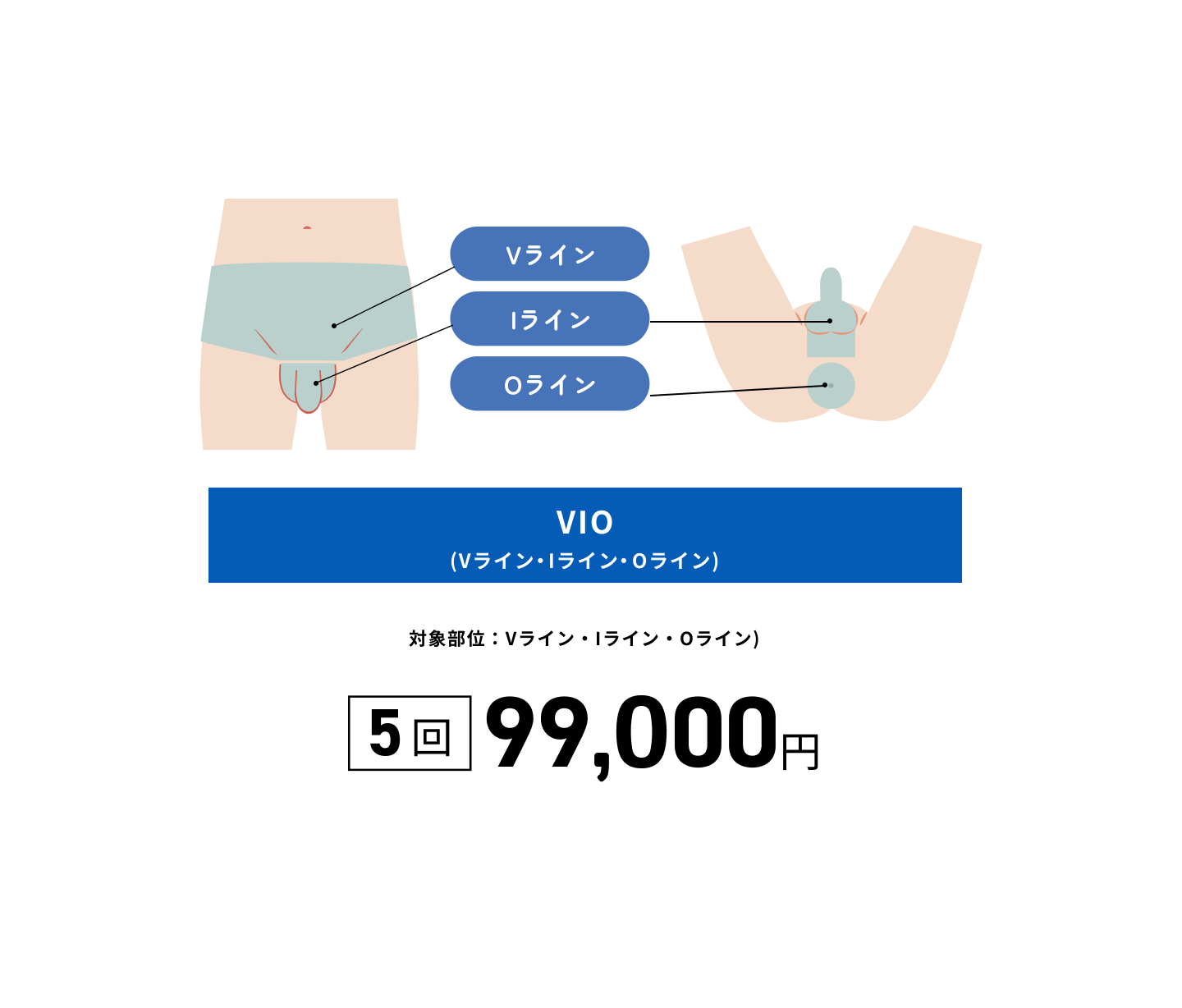 VIO脱毛